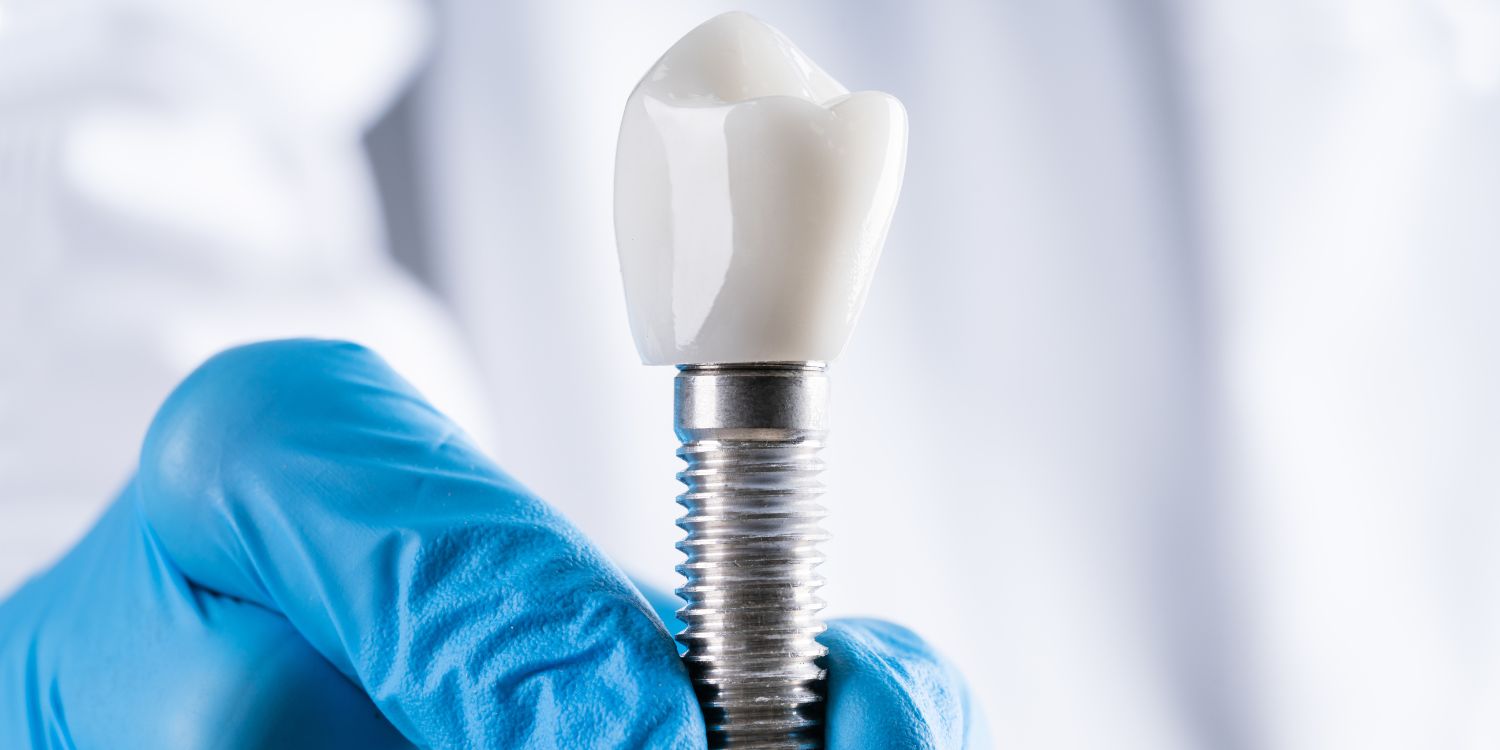 ¿Para qué sirve un poste dental?